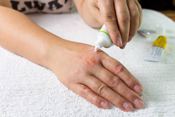 خرید و قیمت کرم ضد عفونت پوست و فروش عمده